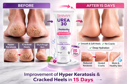 SHAAN Urea 30% Cream Exfoliating For Heavy Flakes & Cracked Foot